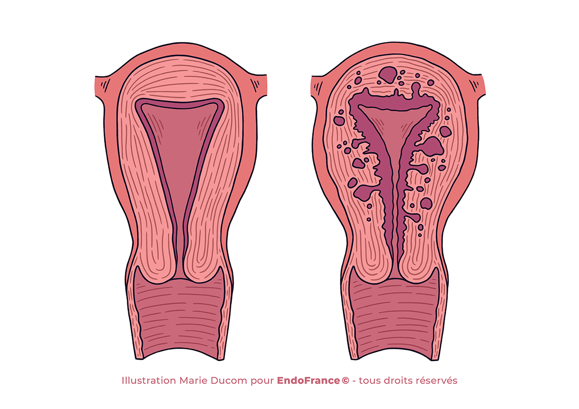 Règles douloureuses et Endométriose